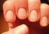 با ناخنهای شکننده و خشکی پوست دستانم چه کنم؟ درمان اگزما و خشکی پوست با هومیوپاتی