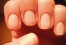 با ناخنهای شکننده و خشکی پوست دستانم چه کنم؟ درمان اگزما و خشکی پوست با هومیوپاتی